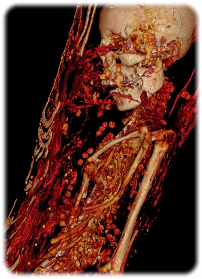 3D-Rekonstruktion der weiblichen Mumie an den Staatlichen Kunstsammlungen Dresden mit Perlen im Brustraum. Aufnahme: German Mummy Project, rem