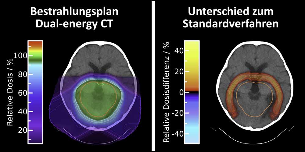 Durch die neuartige Bestrahlungsplanung auf Basis der Dual-Energy Computertomographie (links) lässt sich die Strahlendosis bei der Protonentherapie rings um den Tumor verringern (rechts). Quelle: OncoRay/ Patrick Wohlfahrt