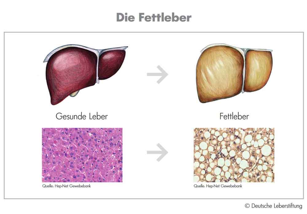 Die Grafik zeigt die Veränderung einer Fettleber. Grafik: Deutsche Leberstiftung