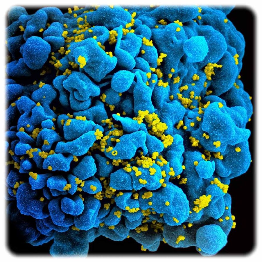 HIV-infizierte T-Zelle unterm Elektronenmikroskop. Foto: NIAID, Wikipedia, CC2-Lizenz