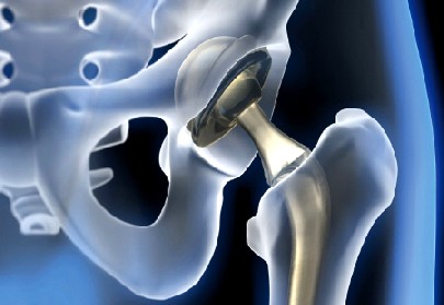 "Endoprotesen" nennt man Implantate, die dauerhaft im Körper verbleiben. Abb.: Netzwerk Endoprothetik
