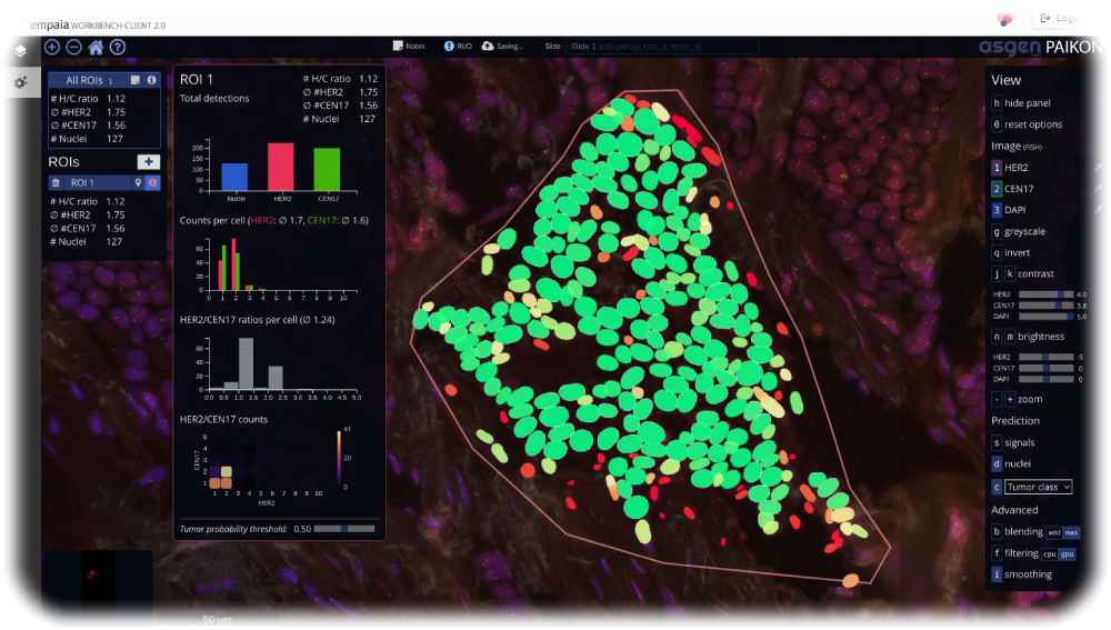 Hier zählt die Künstliche Intelligenz die Krebszellen durch: KI-App KI-App auf der Empaia-Plattform im Uniklinikum Dresden bei der sogenannten "HER2-Genamplifikationsdiagnostik" bei Brustkrebs. Bildschirmfoto: UKD