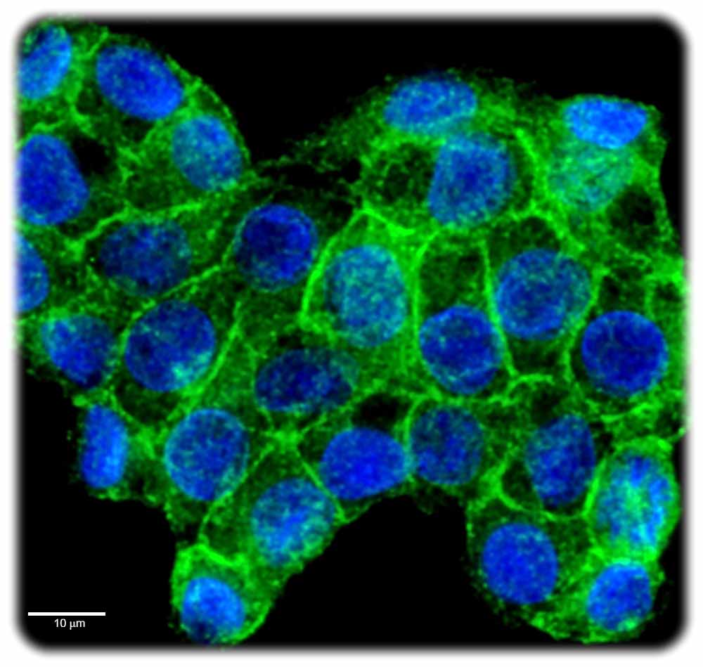 Darmkrebszellen mit PD-L1 Protein (grün) auf der Oberfläche, sichtbar gemacht mittels Immunfärbung, sowie Erbgut-Molekülen (blau). Das Tarnmolekül PD-L1 bremst wichtige Immunzellen aus und wird von vielen Krebszellen vermehrt gebildet. Mikroskopbild: Mirko Theis für das NCT/UCC Dresden