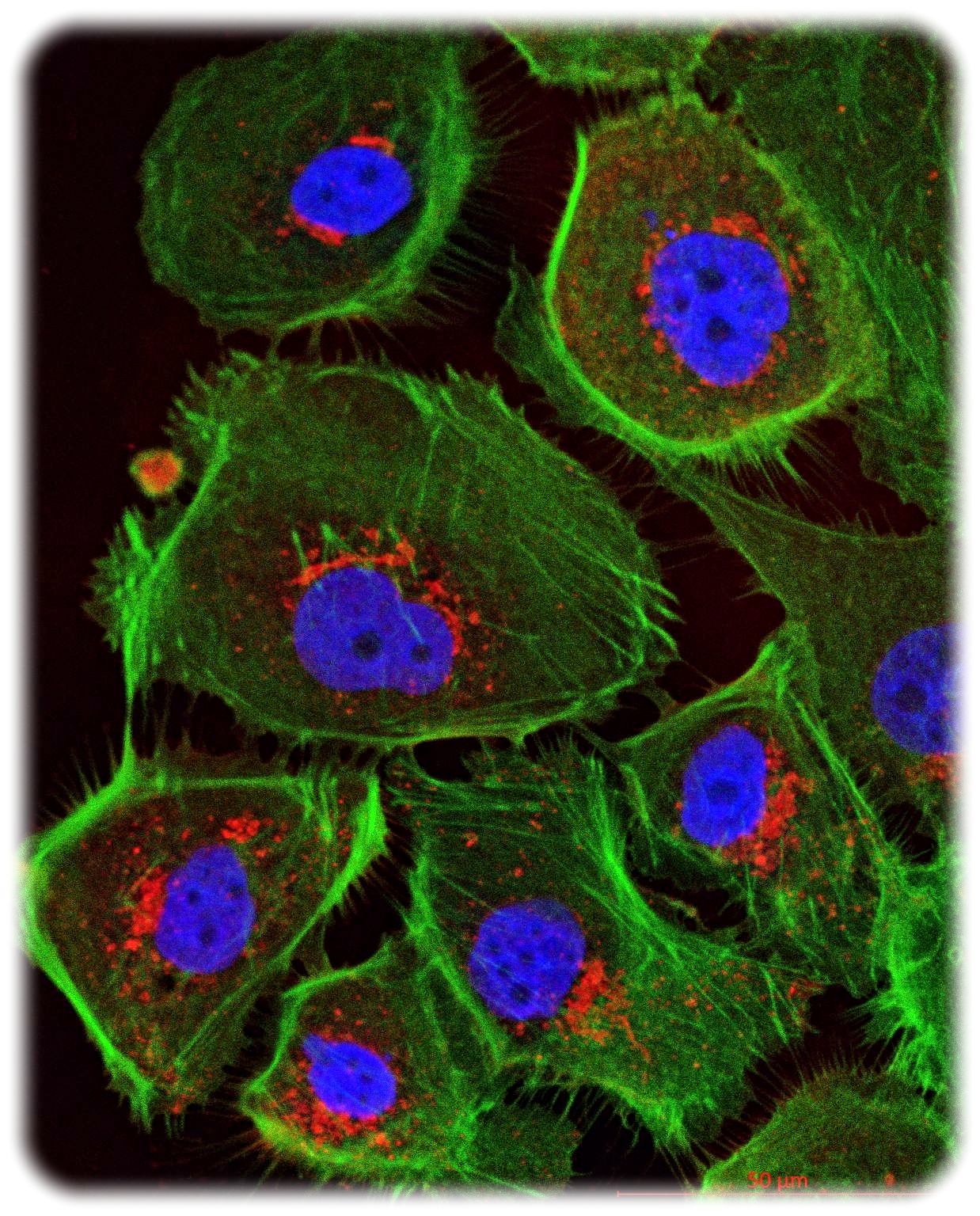 Mikroskopische Ansicht menschlicher Eierstockkrebszellen. Durch Fluoreszenzfarben erscheinen Zellkerne blau und das Zellskelett grün. Aufnahme: Uniklinikum Dresden, Klinik für Frauenheilkunde