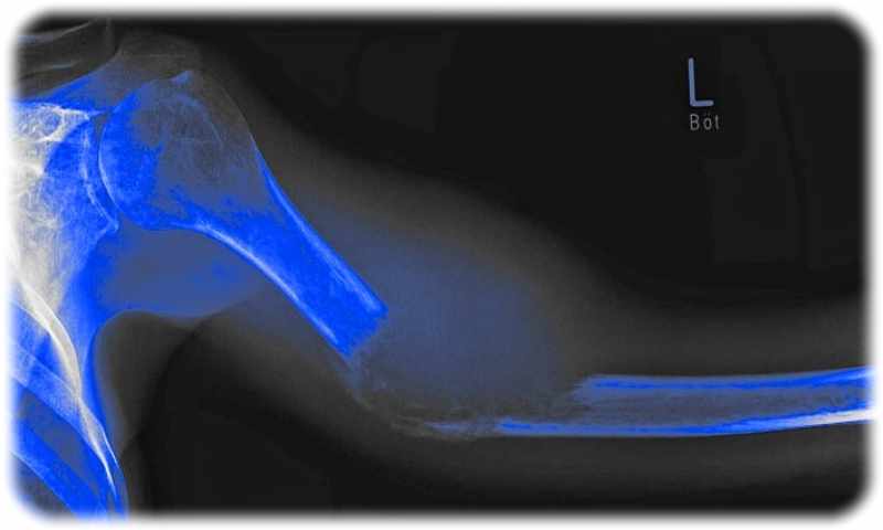 Knochenmetastasen in einer eingefärbten Röntgen-Aufnahme. Abb.: Annett Ludewig für das Bonelab Dresden, 